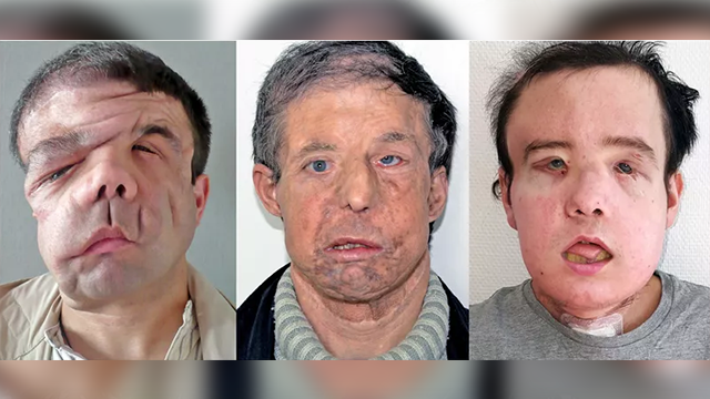 Man's second face transplant is a world first